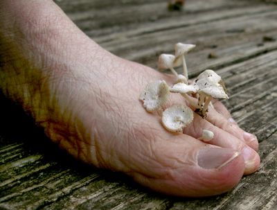 fungus on feet pictures